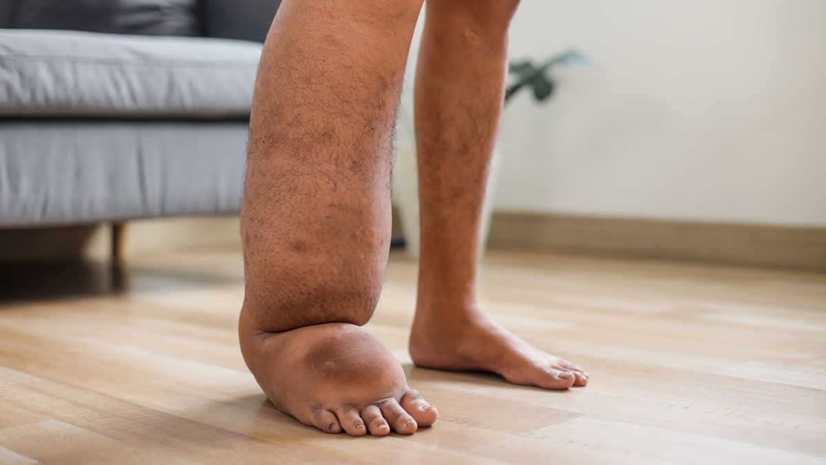 portrait-of-legs-with-filariasis-or-lymphatic-fila-2026-01-09-11-33-36-utc